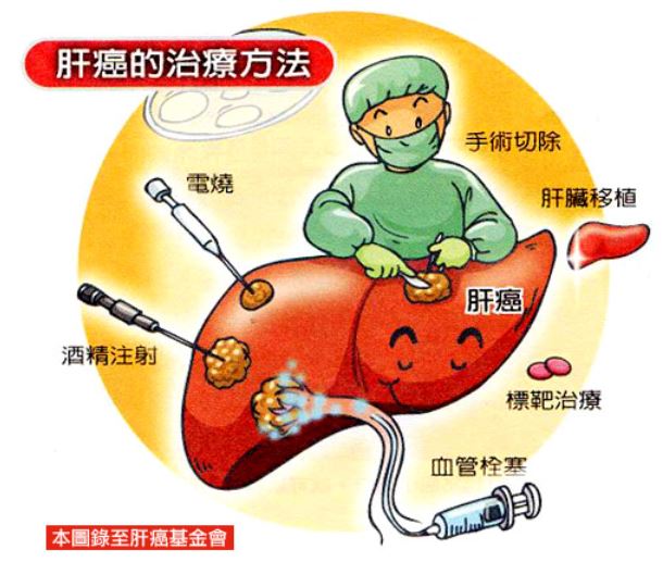台灣肝癌盛行率肝癌免疫治療成功率